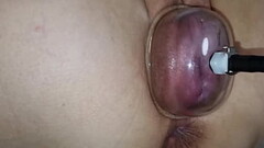 Using a pussy pump to swell my pussy lips and my swollen vagina Thumb