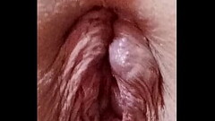 Joe'_s prolapse anus Thumb